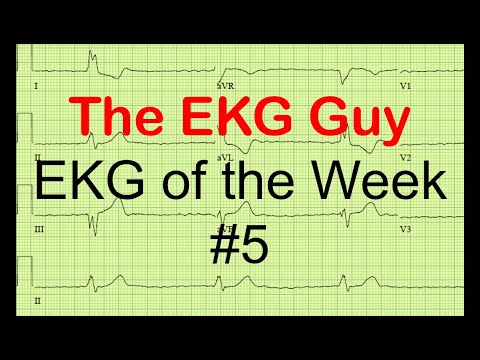 EKG/ECG of the Week #5 | The EKG Guy - www.ekg.md