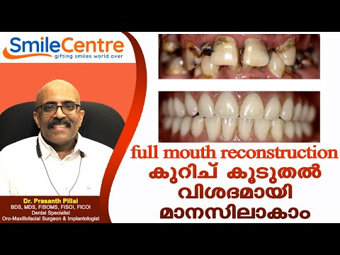 Full Mouth Resconsturction at FMS Wing of Smile Centre India