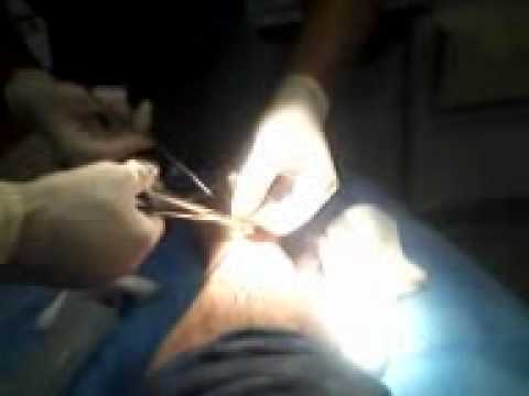 penisuri după operație)