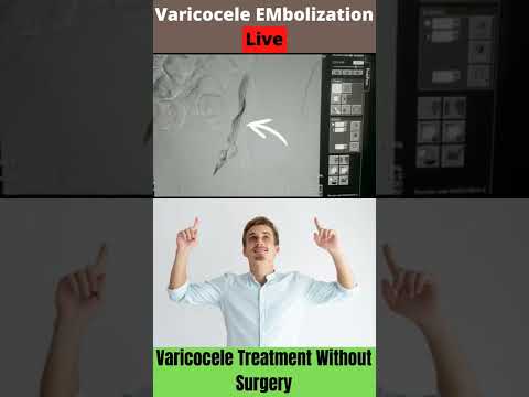 Live Varicocele Embolization Procedure #varicocele #shorts #viral #trending #reels #india #health