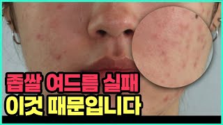 화농성 여드름 관리 방법으로 좁쌀 관리하면 좁쌀 더 생기는 이유