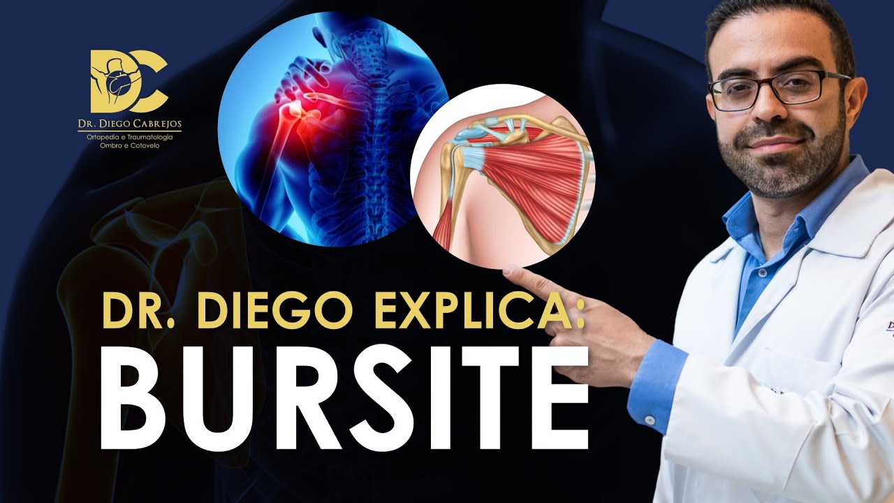 Bursite no ombro: causas, sintomas e tratamento.  Qual a importância da fisioterapia? É grave?