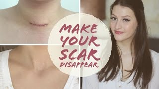 HOW TO FADE SURGERY SCARS | Thyroidectomy | Scar Care | Graves&#39; Disease