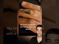 Lead stuck in the finger