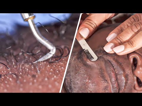 Ingrown Hair Treatment