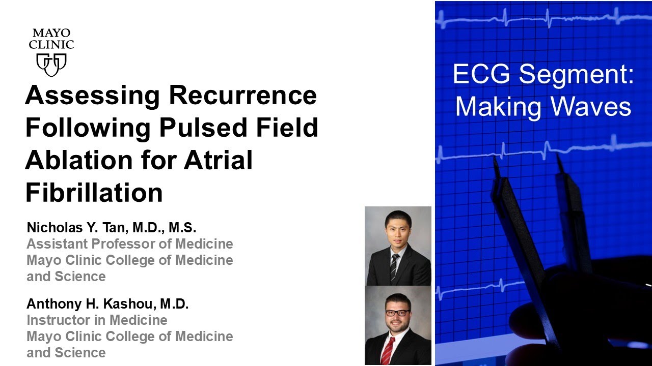 Assessing Recurrence Following Pulsed Field Ablation for Atrial Fibrillation