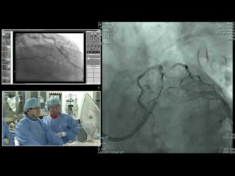 [TCTAP 2017] Coronary Symposium - Live Case & Lecture Session VII