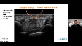 Ultrasound-guided Peripheral Nerve Hydrodissection