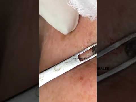 Removing a BIG Dilated Pore of Winer |Dr. Pimple Popper #shorts #drpimplepopper