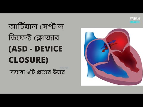 এএসডি- ডিভাইস ক্লোজার - ৬ টি প্রায়শই জিজ্ঞাসিত প্রশ্ন