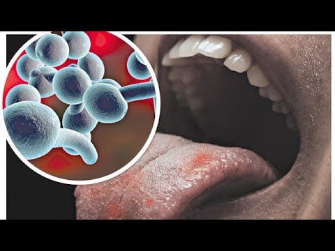 Myku i gojës prek shumë shqiptarë - Ja si ta shëroni me kto produkte që i keni në shtëpi dhe as …