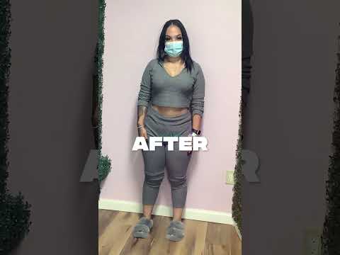 -41 Lbs In 6 Month After Her Orbera Gastric Balloon Procedure 🔥❗️ #nonsurgicalweightloss