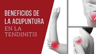 Beneficios de la Acupuntura en la Tendinitis