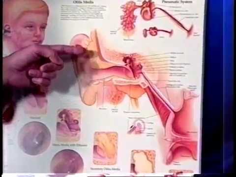 Pressure Equalization Tubes (Ear tubes)-Dr Michael Seidman, MD