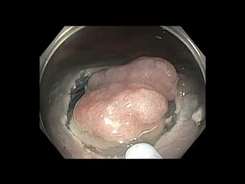 Colonoscopy: Rectum - LST - Mixed Tumor - Hybrid EMR