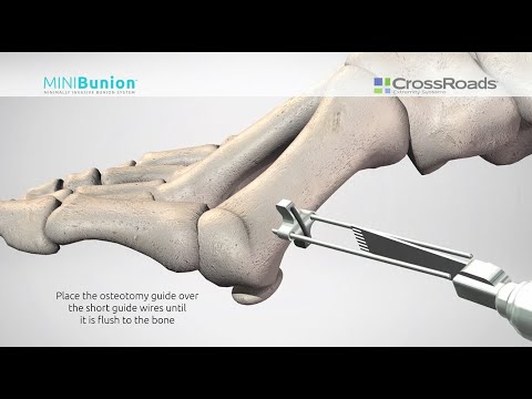 Minimally Invasive Bunion Surgery with CrossRoads MINIBunion™ System - Surgical Animation