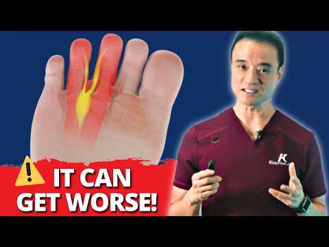 Can Morton’s Neuroma Turn Into Neuropathy? (What Most Doctors Don’t Tell You)