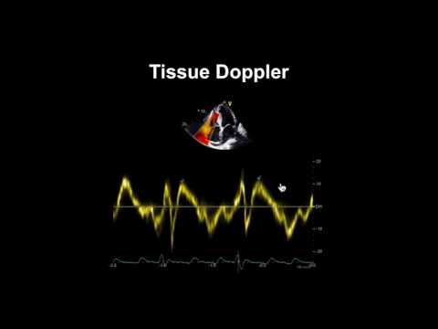 Echocardiography Essentials: Evaluating right ventricular size and function
