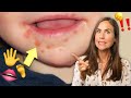 Hand, Foot, and Mouth Disease: What It Is & How to Treat It Naturally