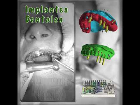 Cirugía de implante dental en Barranquilla - Maxilofacial Fragozo - Implantes Dentales