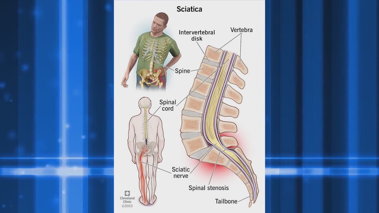 Limitless Therapy and Wellness - Sciatica Pain And Treatment