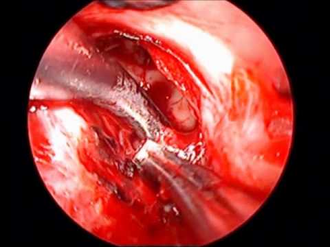 Neurohypophisis - Glandular Cell Tumor