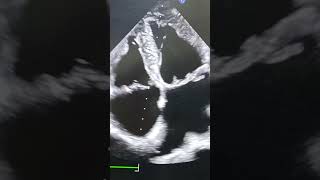 Download lagu 'Bilateral Atrial Enlargement on A4C Heart Imaging | #Echocardiography #HeartHealth #Cardiology' mp3 Download lagu 'Bilateral Atrial Enlargement on A4C Heart Imaging | #Echocardiography #HeartHealth #Cardiology' mp3