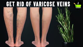 Get Rid Of Varicose Veins & Joint Pain |  Effective Home Remedies for Varicose Veins | Home Remedies