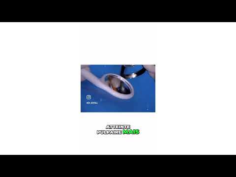 Coiffage pulpaire direct – Endodontie