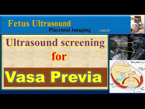 Fetus Ultrasound, Sonographic screening for Vasa Previa