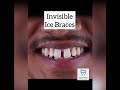 How Braces Are Put On Crystal Clear Braces Shorts