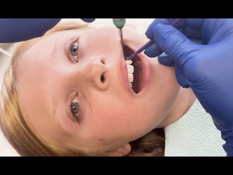 Award-Winning FluoroDose Fluoride Varnish Application