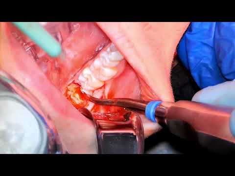 Lower Third Molar Impactions 