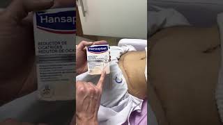 TERAPIA PARA MEJORAR LA CICATRIZ POSQUIRURGICA