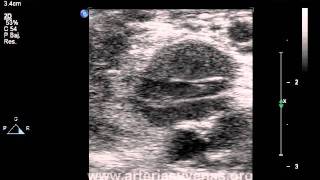 preview picture of video 'Válvula venosa (Venous valve) - Arterias y Venas'