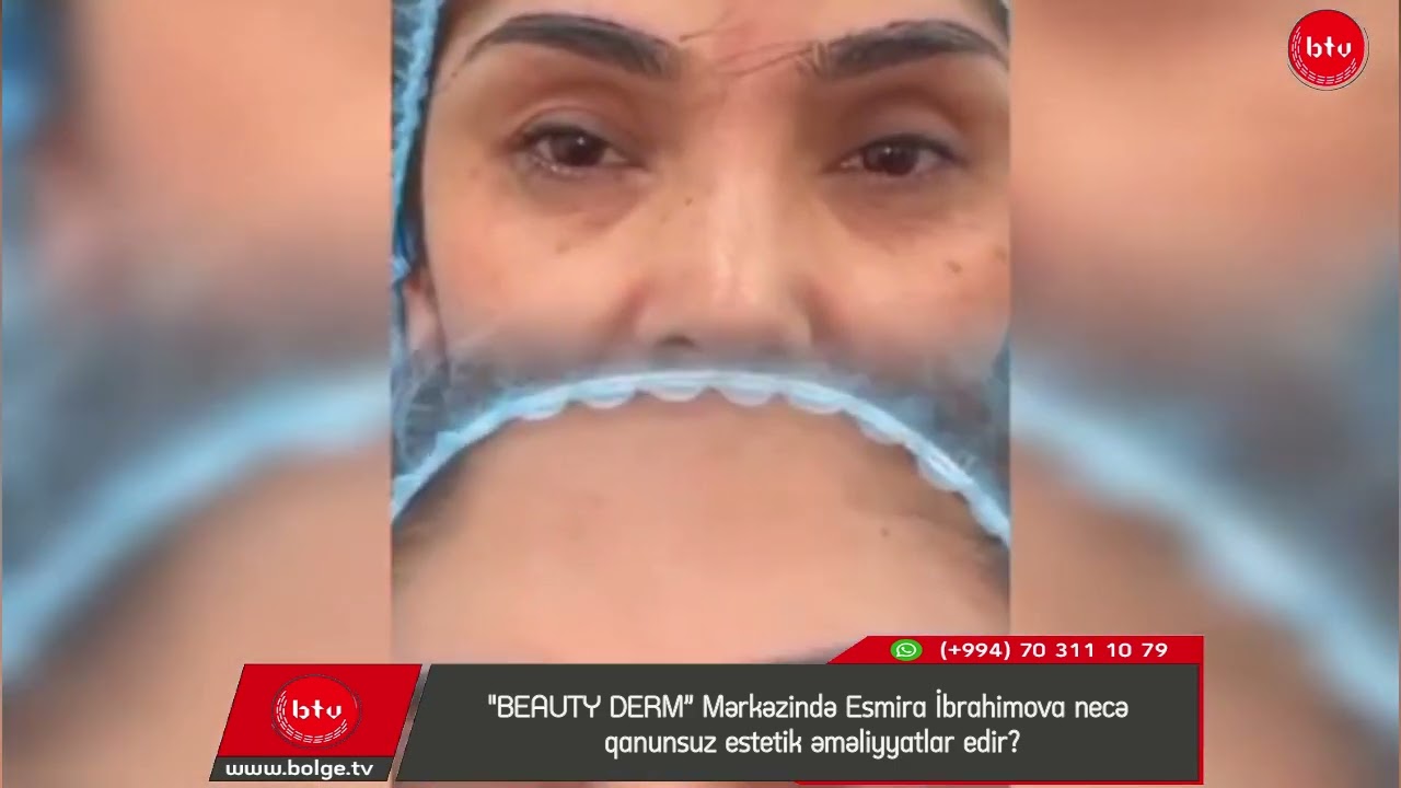 "BEAUTY DERM” Mərkəzində Esmira İbrahimova necə qanunsuz estetik əməliyyatlar edir?
