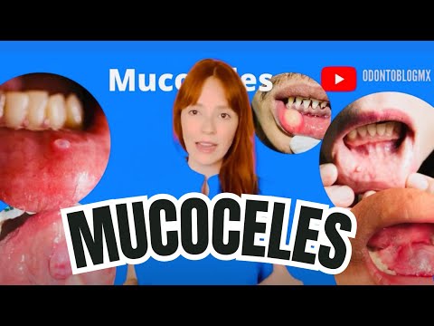 MUCOCELE