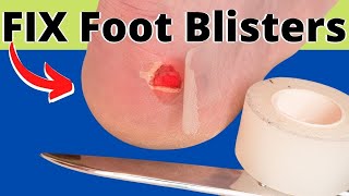 How To Treat FOOT Blisters, TOE Blisters & HEEL Blisters FAST [2024]
