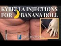 Kybella For Banana Roll Before And After