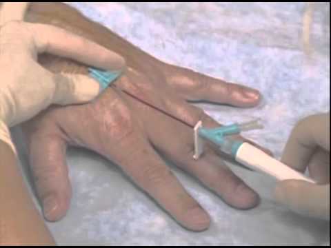 BD Saf-T-Intima™ Closed IV Catheter System Insertion Technique