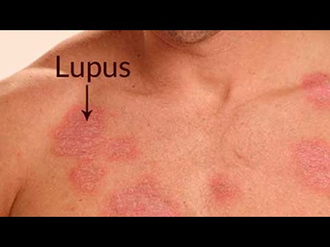 Cualquiera que sea la presión arterial No hay signos de hipertensión intracraneal