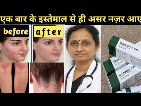 dermovate cream for acne | dermovate cream review | How to use | benefits | side effects