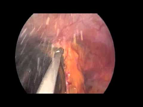 Transvaginal Nephrectomy Dissection of Adhesions