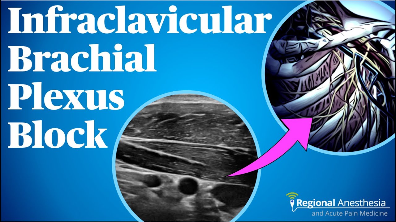 Infraclavicular Brachial Plexus Block
