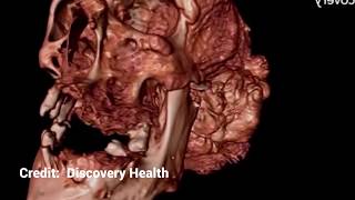 World's Biggest Face Cyst?