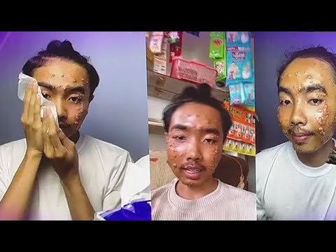 Man says he got a skin disease from second-hand clothing
