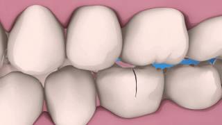preview picture of video 'Cracked Teeth | Coastal Endodontics Richmond Hill, GA'