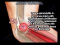 Tennis Elbow Muscle Extensor Carpi Radialis Brevis Everything You Need To Know Dr Nabil Ebraheim