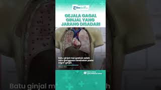 Gejala Awal Batu Ginjal yang Jarang Disadari, Termasuk Sakit hingga Nyeri Pinggang