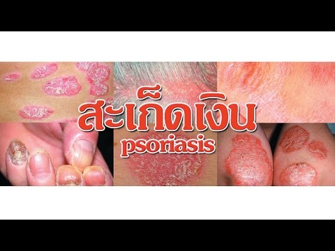 กลากและเส้นประสาทความสัมพันธ์ มุ่งหน้าครีมไม่ฮอร์โมนสำหรับโรคสะเก็ดเงิน